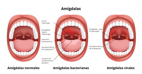 Ilustración detallada de la lengua y las amígdalas mostrando posibles zonas de acumulación bacteriana