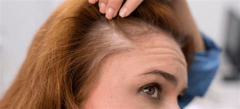 Persona preocupada por la caída del cabello, mostrando antes y después del tratamiento