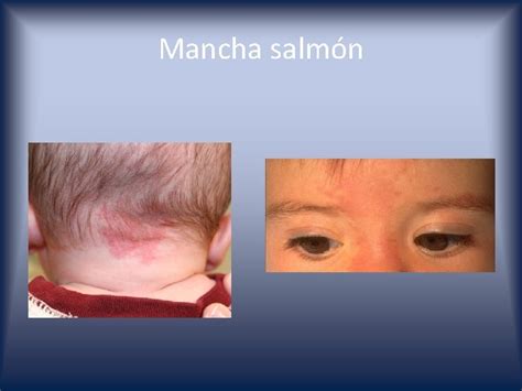 Diferencias entre mancha salmón y nevus flammeus