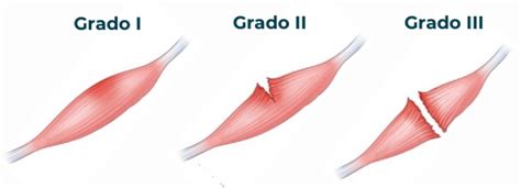 Esquema de los grados de desgarro muscular: grado 1 (distensión leve), grado 2 (rotura parcial), grado 3 (rotura completa)