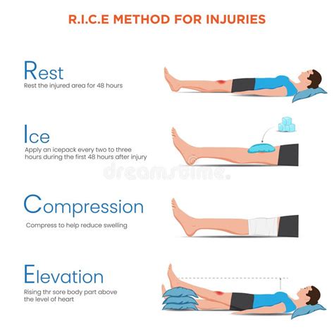 Ilustración del método PRICE (Protect, Rest, Ice, Compress, Elevate) para lesiones musculares