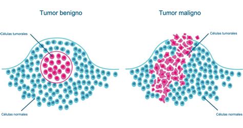 Diferencias visuales entre un bulto mamario benigno y uno maligno