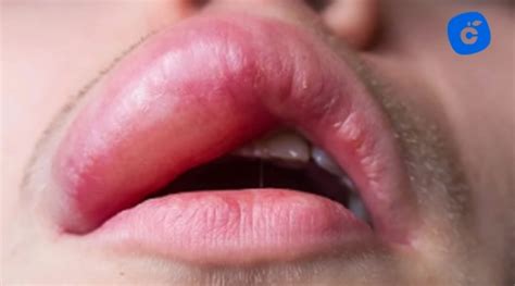 Fotografía de labios con hinchazón y enrojecimiento leve
