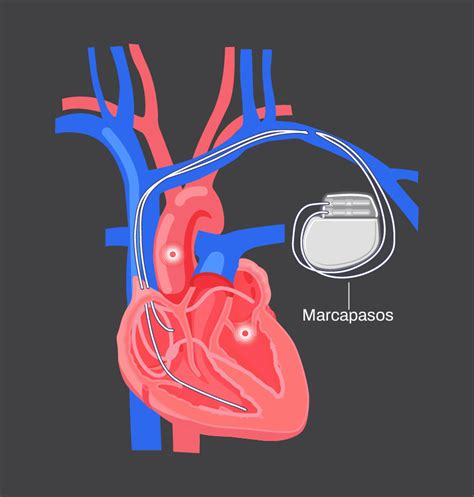 Esquema de un marcapasos cardíaco implantado con sus componentes