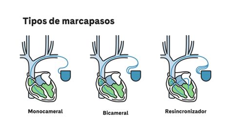 Diagrama de diferentes tipos de marcapasos según las cámaras cardíacas estimuladas (unicameral, bicameral, tricameral)
