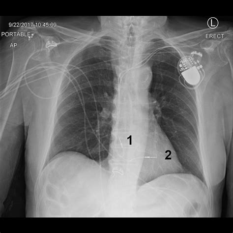 Radiografía torácica de un paciente con un marcapasos implantado en la parte superior izquierda del tórax con derivaciones en la aurícula derecha y el ventrículo derecho.