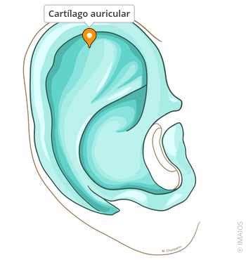Esquema anatómico que muestra el hematoma entre el pericondrio y el cartílago auricular