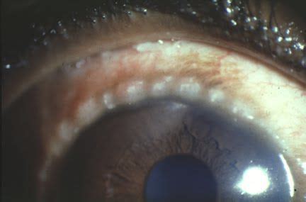 Fotografía de ojo con nódulos de Horner-Trantas