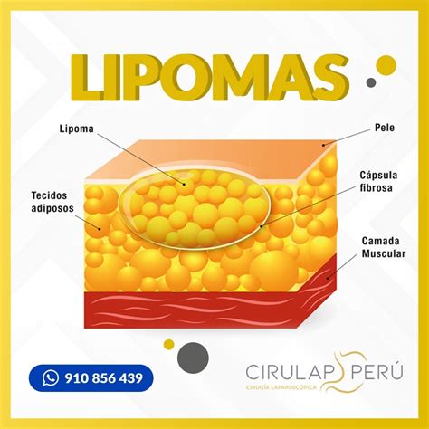 Representación esquemática de un lipoma bajo la piel, mostrando su composición de tejido graso y su movilidad.