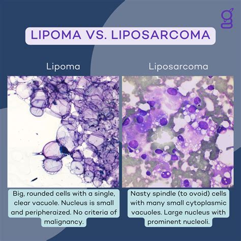 Imagen comparativa de un lipoma benigno y un liposarcoma maligno, destacando sus diferencias en textura, movilidad y velocidad de crecimiento.