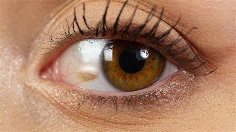 imagen de un ojo con una pinguécula visible