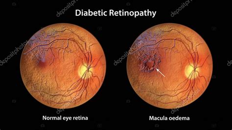 Ilustración de retina con edema macular