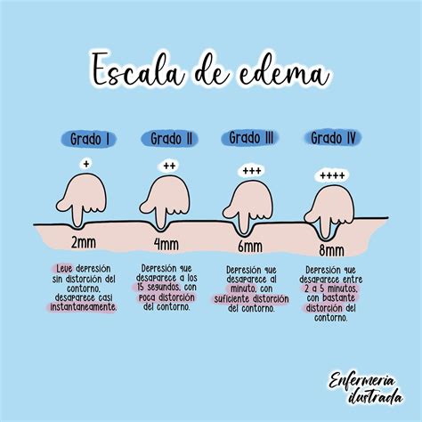 Tabla con la escala de clasificación del edema con fóvea