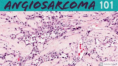 Fotografía de un paciente con angiosarcoma facial