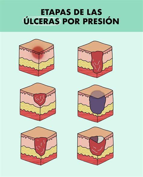 Infografía detallando las etapas de desarrollo de una úlcera por presión y las medidas preventivas.