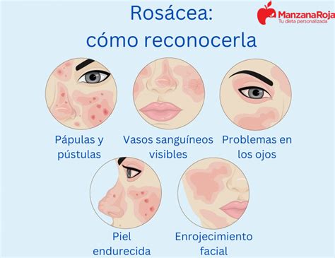 Esquema de las áreas faciales afectadas por la rosácea y sus síntomas principales