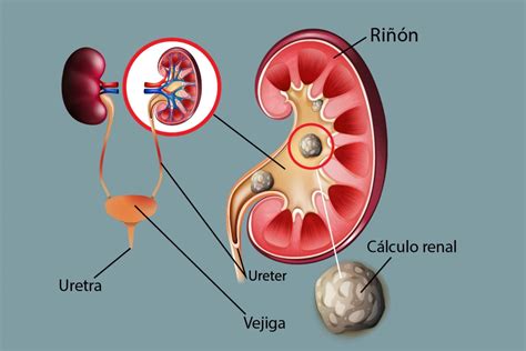 Esquema de los riñones y el sistema urinario con la ubicación de los cálculos renales