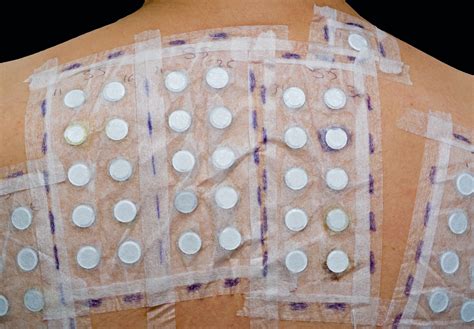 Representación de una prueba de parche cutánea en el antebrazo