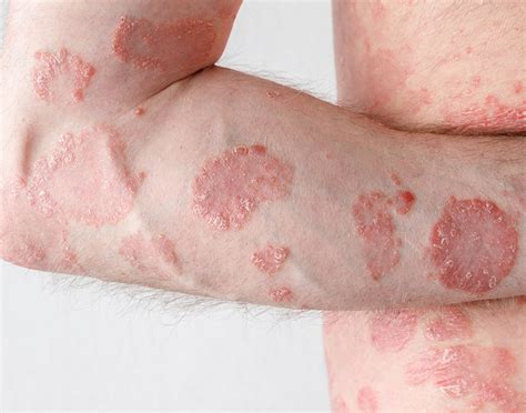 Infografía detallada sobre los síntomas comunes de la psoriasis: placas rojas, descamación blanquecina y zonas de mayor afectación como codos y rodillas