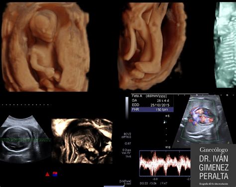 Ecografía de un feto de 17 semanas mostrando su perfil, incluyendo la órbita, nariz, boca, abdomen y placenta.