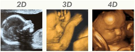 Imágenes de ecografía 3D y 4D de un feto, mostrando detalles faciales o de movimiento