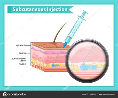 Mapa de rotación de sitios de inyección para terapia subcutánea