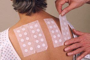 Ilustración mostrando la aplicación y lectura del Patch Test en la espalda