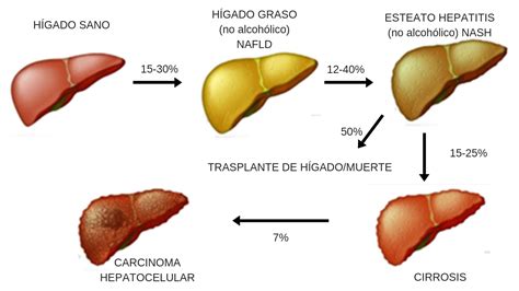 Esquema de un hígado sano vs. un hígado graso con acumulación de lípidos en hepatocitos