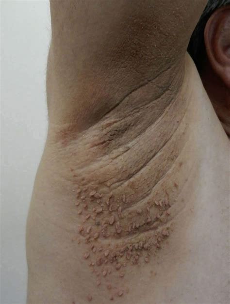 Esquema anatómico mostrando las zonas comunes de aparición de acrocordones: cuello, axilas e ingles.