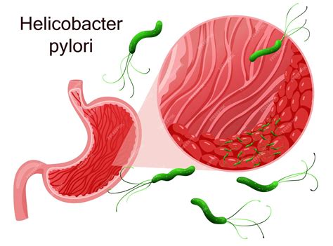 Ilustración de la bacteria Helicobacter pylori