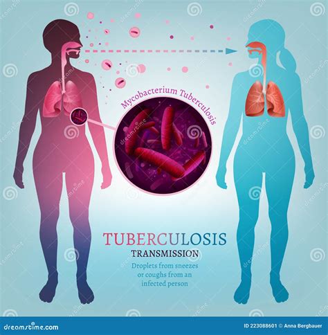 Ilustración médica mostrando la transmisión de enfermedades infecciosas.