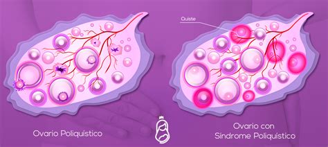Diagrama de ovarios con folículos poliquísticos vs. ovarios normales