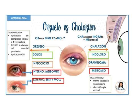 Diagrama mostrando la diferencia entre orzuelo y chalazión