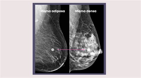 Esquema anatómico de la mama mostrando el tejido adiposo, glandular y conectivo