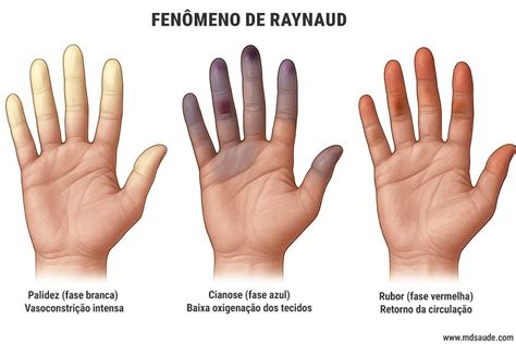 Ilustración de las fases del Fenómeno de Raynaud en los dedos