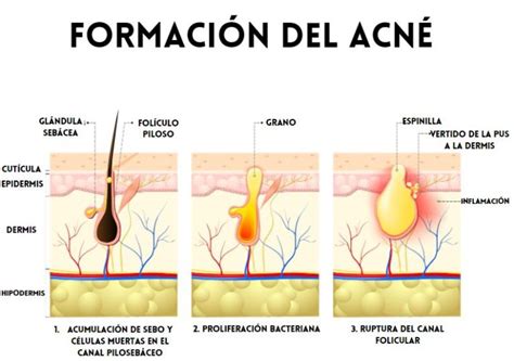 Esquema sobre la formación del acné debido a la obstrucción de los poros por exceso de sebo y células muertas