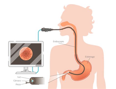 esquema de una endoscopia digestiva superior