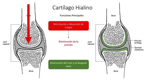 Esquema anatómico que muestra la formación de un hematoma entre el cartílago y el pericondrio