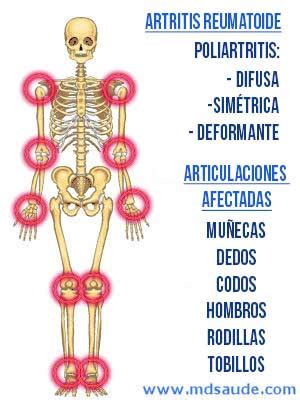 Esquema de las articulaciones afectadas por la artritis reumatoide con áreas inflamadas