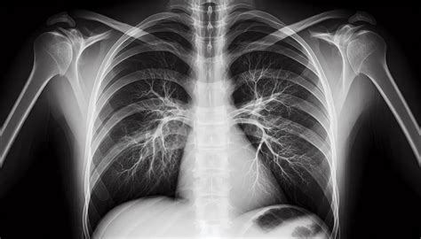 Radiografía de tórax mostrando una masa en el ápice pulmonar derecho, característica del síndrome de Pancoast.