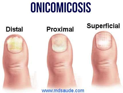 Ilustración comparativa de uñas sanas y uñas con diferentes tipos de onicomicosis (distal, proximal, blanca superficial).