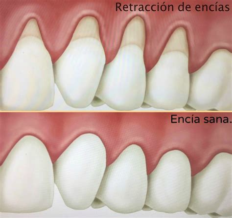 Ilustración de la retracción de encías y su impacto en la raíz del diente