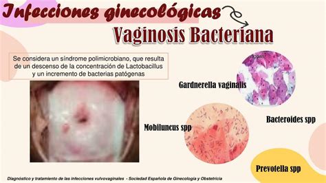 Representación visual de las diferencias clave en los síntomas entre la vaginosis bacteriana y la infección por levaduras, destacando el tipo de secreción y la presencia de olor.