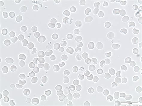 Microfotografía comparativa de eritrocitos isomórficos frente a eritrocitos dismórficos.