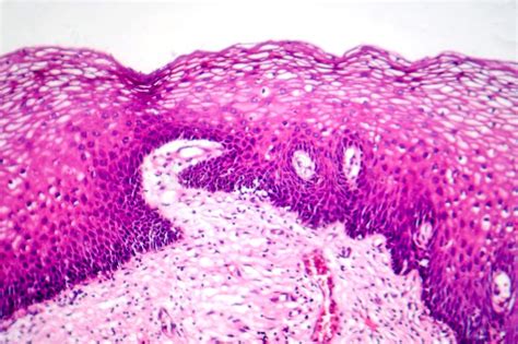 Corte histológico de aleta caudal de salmón con hiperplasia epitelial y Caligus
