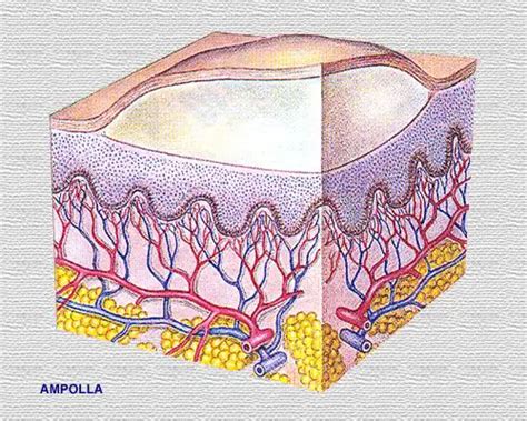 Esquema de la piel y formación de ampollas en la dermatitis herpetiforme