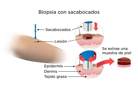 Micrografía de depósitos de IgA en biopsia de piel para diagnóstico de DH