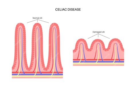 diagrama de vellosidades intestinales sanas y dañadas por enfermedad celíaca
