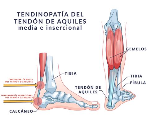 Ilustración de una persona con dolor en el tendón de Aquiles, resaltando la zona afectada.