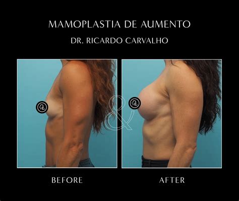 Comparativa antes y después de una mamoplastia de reducción